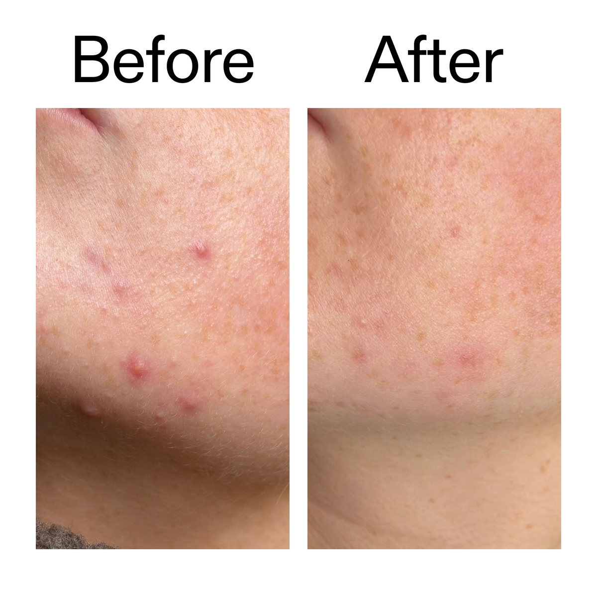 10-azelaic-acid-serum-for-redness-relief-o5 B_A_1_PPAGE.png