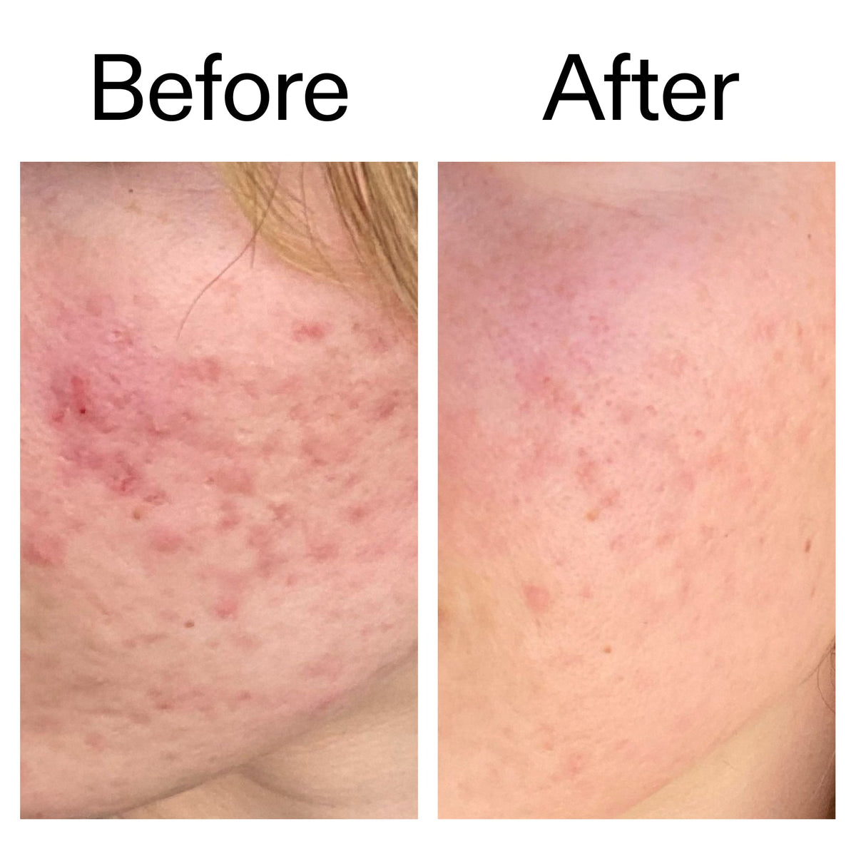 10-azelaic-acid-serum-for-redness-relief-o5 Azealic_Acid_Serum_B_A_Ppage_2000_x_2000.jpg