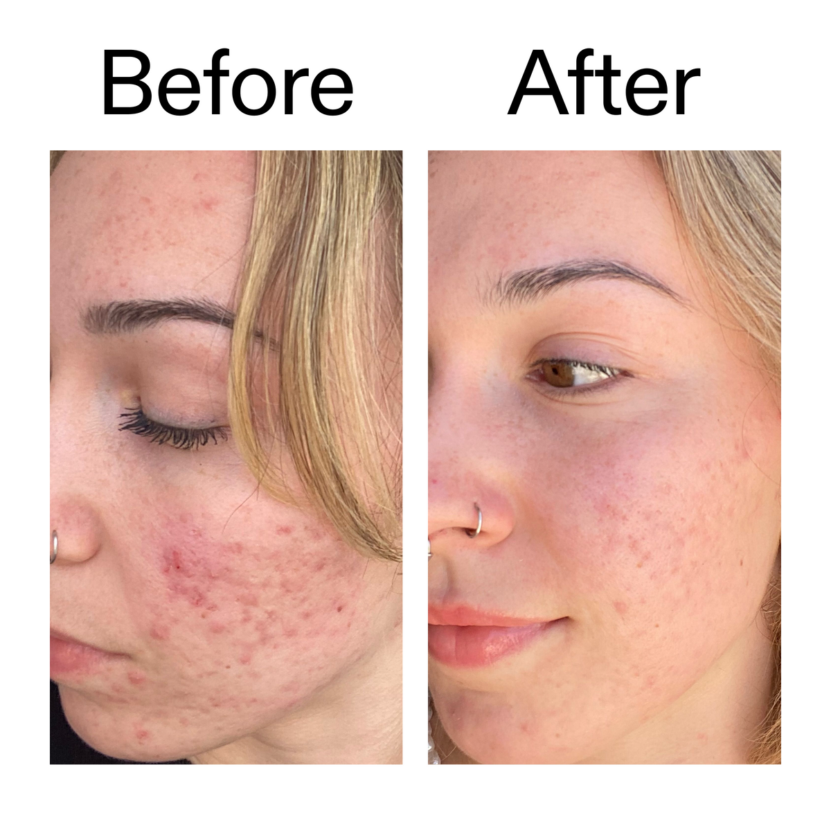 10-azelaic-acid-serum-for-redness-relief-o5 B_A_2_PPAGE.png