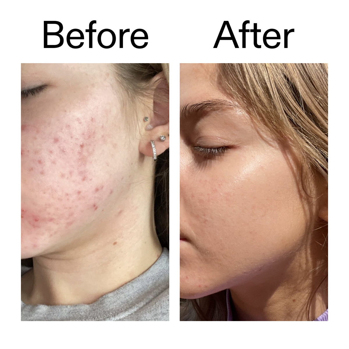 beta-hydroxy-acid-bha-serum-l1 Beta_Hydroxy_Acid_Serum_Before_After_2000x2000_96fda3e5-938d-49ef-bcf2-a0fa6ece4e2c.jpg