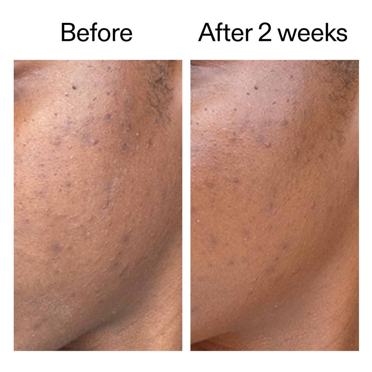 360-acne-clearing-duo-e2 DIOICB_A2000x2000.jpg