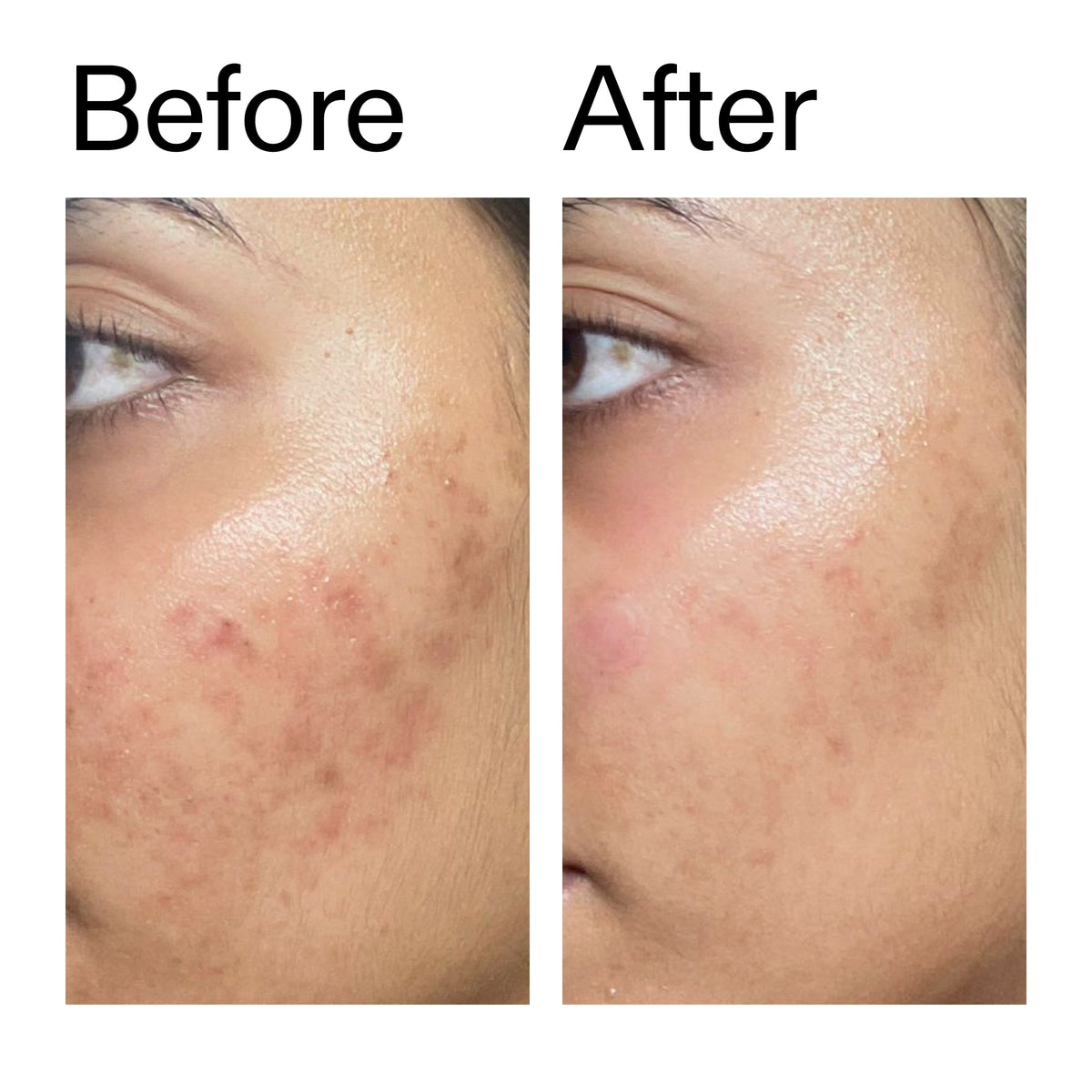 ectoin-hydro-barrier-serum-r7 Ectoin_Hydro-barrier_Serum__Before_After_2000x2000_34261920-d004-48d0-9c7b-8e1c15971bfd.jpg