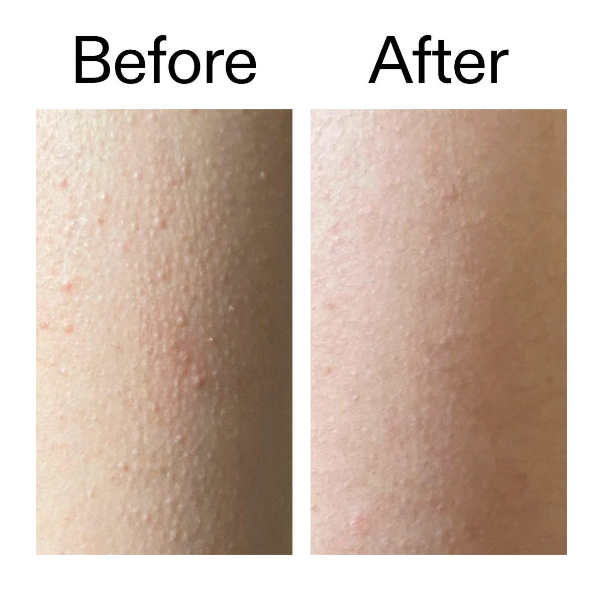 glycolic-acid-exfoliating-body-stick-w6 Glycolic_Acid_Exfoliating_Body_Stick_Before_After_V2_2000x2000_2e4ba052-94f6-4d56-82df-7bdb5b2df7ae.jpg