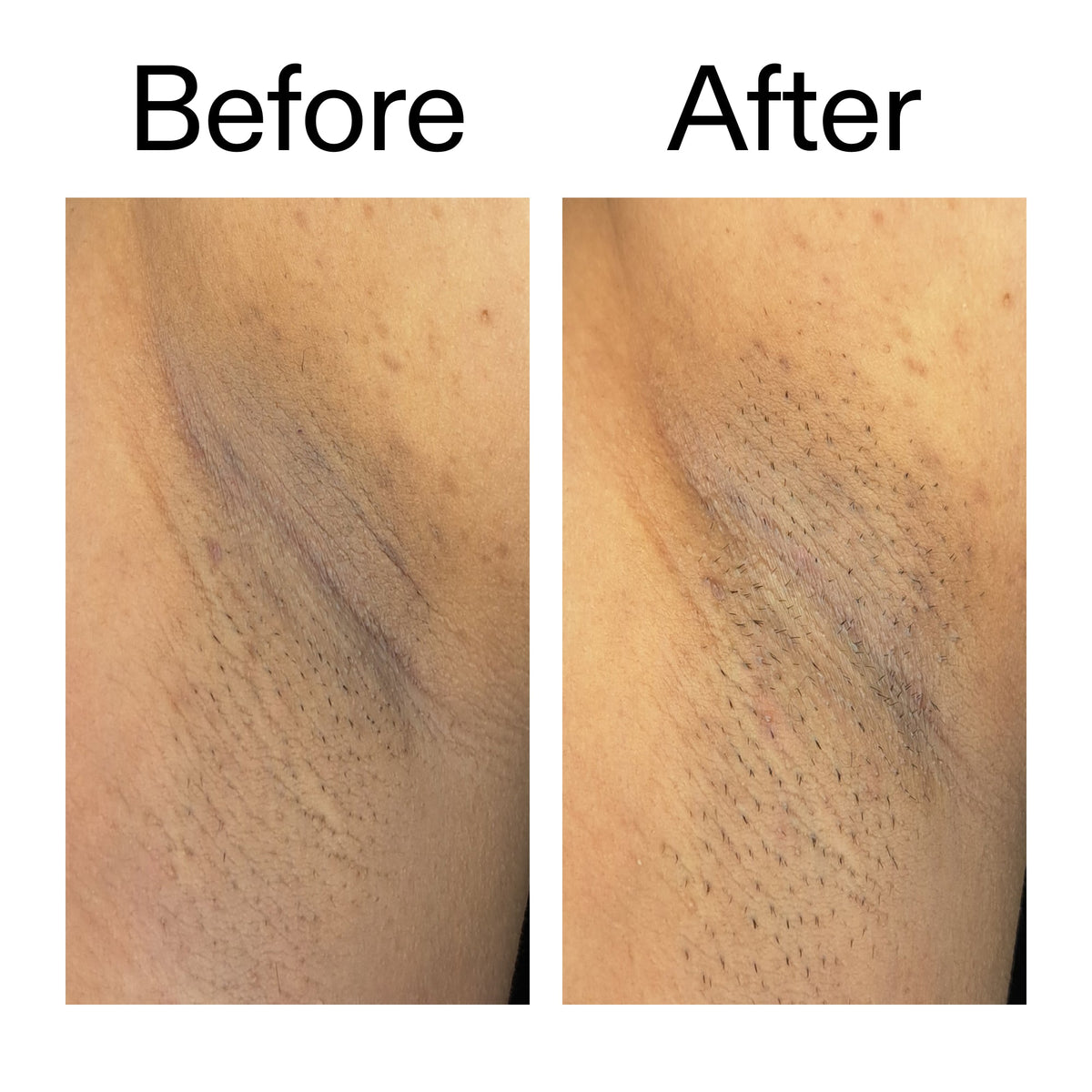 glycolic-acid-exfoliating-body-stick-w6 Glycolic_Acid_Exfoliating_Body_Stick_Before_After_V3_2000x2000_ea919cd9-1439-4a46-82a0-76200eb5bb42.jpg