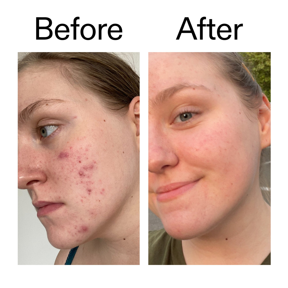 glycolic-acid-toner-k9 Glycolic_Acid_Toner_Before_After_2000x2000_49f0b9f7-e71b-4b2e-a8f8-2ea4b73247bb.jpg