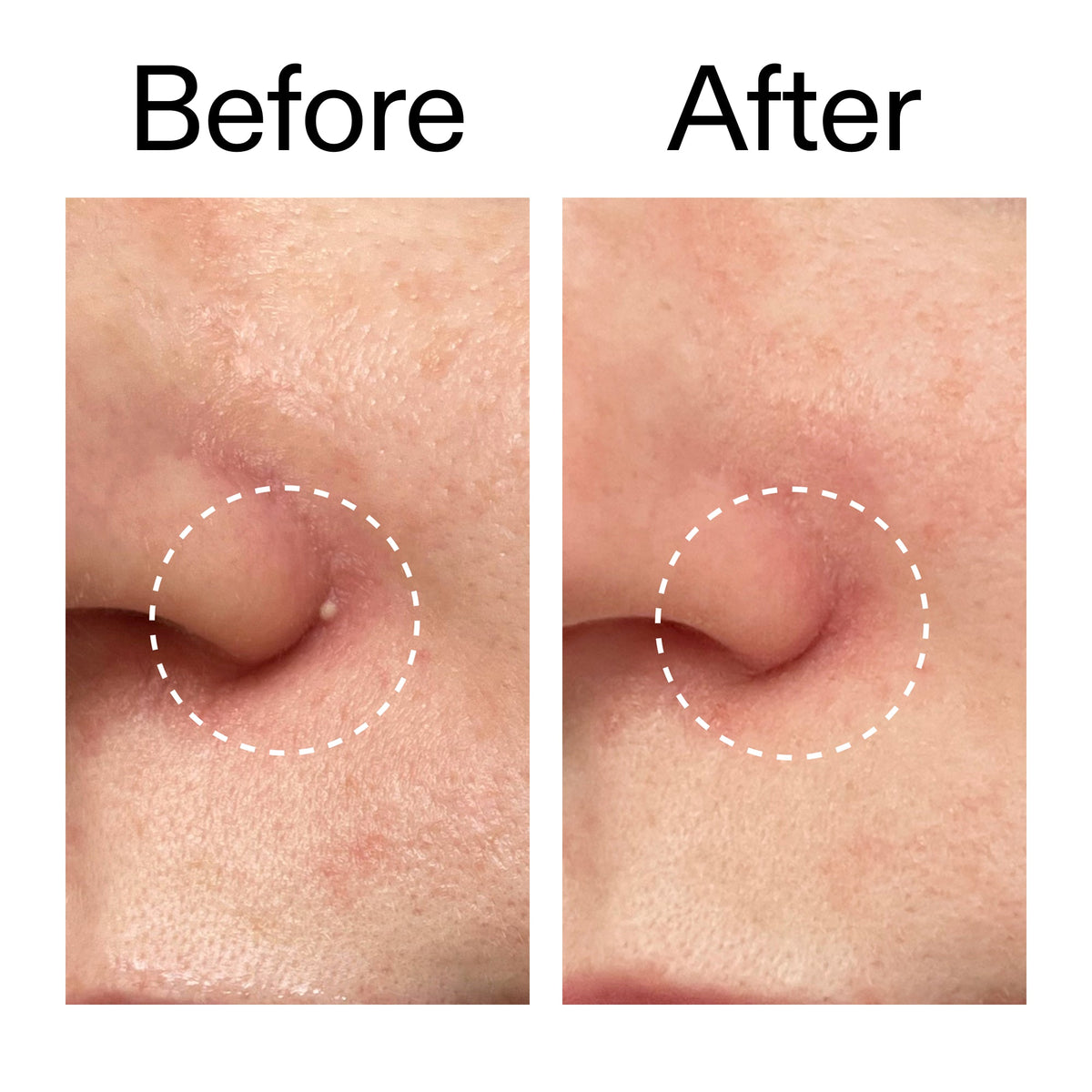 hydrocolloid-invisible-pimple-patches-pack-of-44-x4 Hydrocolloid_Invisible_Pimple_Patches_Before_After_2000x2000_b02aa37b-c78a-4682-91de-9135af5bb7df.jpg
