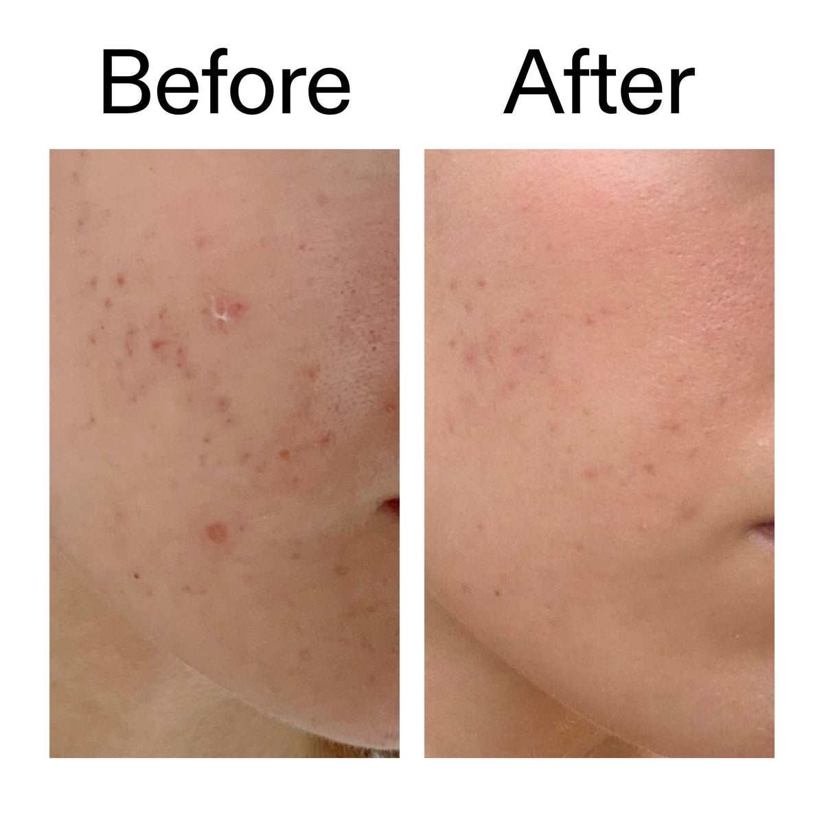 mandelic-acid-treatment-h4 Mandelic_Acid_Treatment_Before_After_2000x2000_4885ac6e-c5d7-4279-a72a-1417af7dce35.jpg
