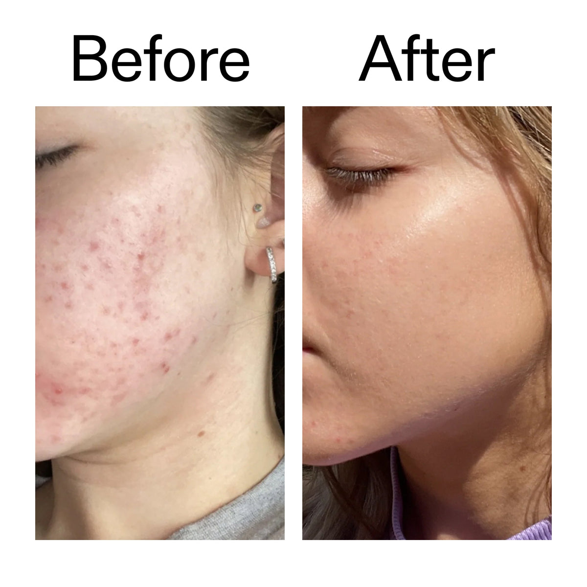 10-niacinamide-serum-e0 Niacinamide_Serum_Before_After_2000x2000_bde32455-9e7d-448e-b053-bef41504f0a9.jpg
