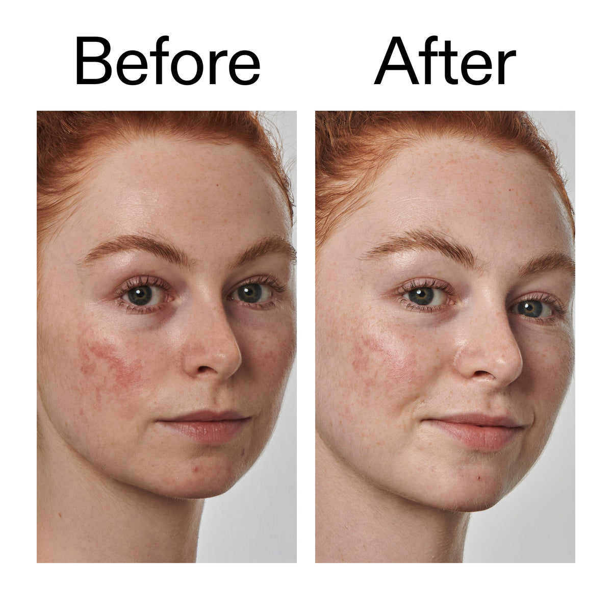 10-azelaic-acid-serum-for-redness-relief-o5 Redness_Relief_Serum_Before_After_2000x2000_3334dc9a-cce9-4e00-8aec-7ad89ca051f2.jpg