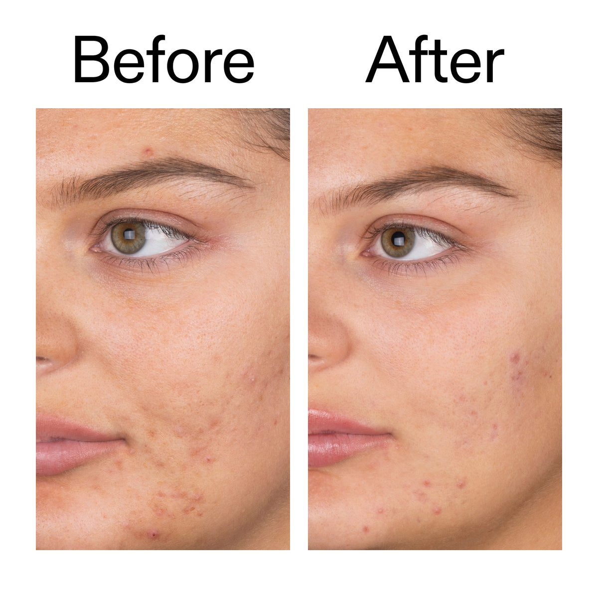salicylic-acid-cleanser-150ml-a2 Salicylic_Acid_Cleanser_-_150ml_Before_After_2000x2000_e7230494-853f-4b07-82b1-27669104c995.jpg