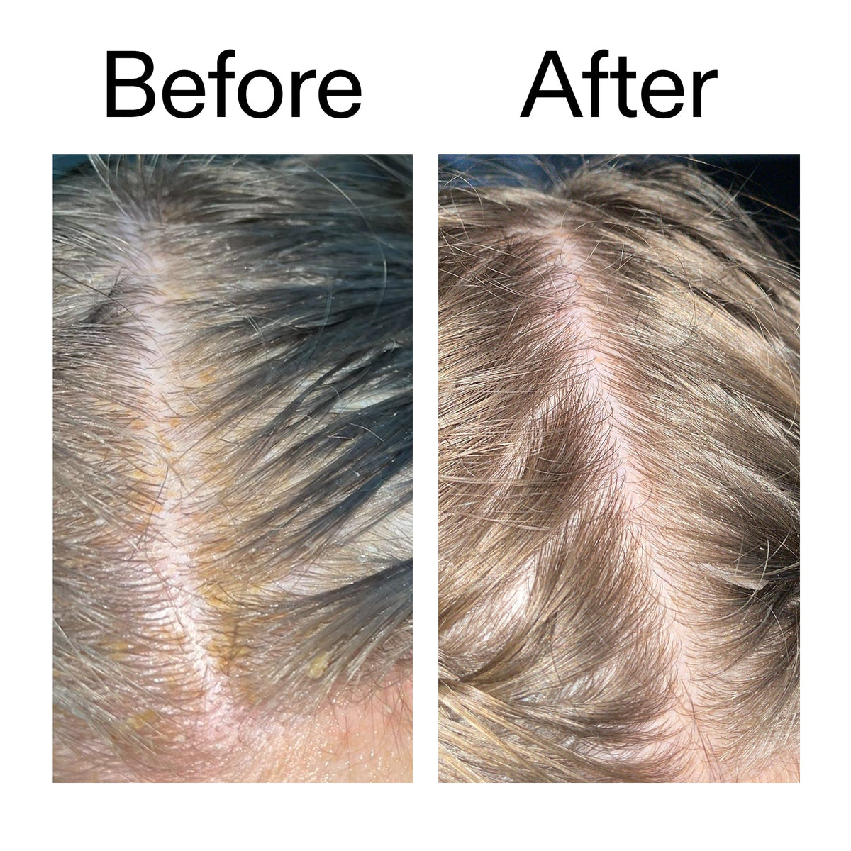 salicylic-acid-exfoliating-scalp-treatment-s5 Salicylic_Acid_Exfoliating_Scalp_Treatment_Before_After_2000x2000_e572a30f-057c-4a48-823b-1c09dc97f8d0.jpg