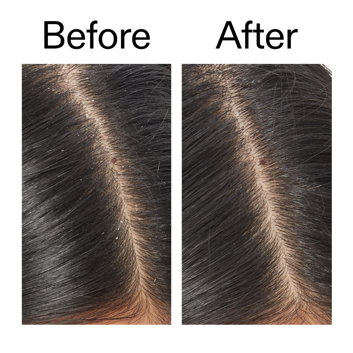 salicylic-acid-exfoliating-scalp-treatment-f7 Salicylic_Acid_Exfoliating_Scalp_Treatment_Before_After_V2_2000x2000_02bd61ad-42bf-490b-b3e3-7e04b2e8a673.jpg